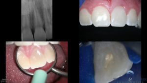 Management Of Pulp Horns – The Endo Fix