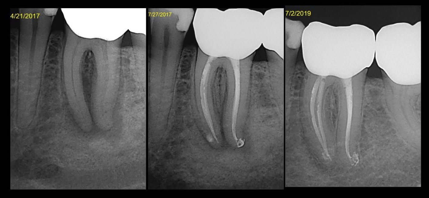 Bilateral EndoPerio Cases The Endo Fix