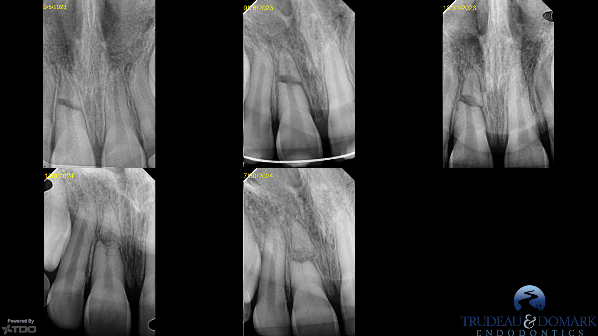 Horizontal Root Fracture – The Endo Fix