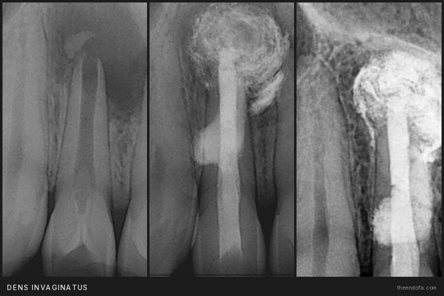 Dens invaginatus case: preop, postop and recall radiographs