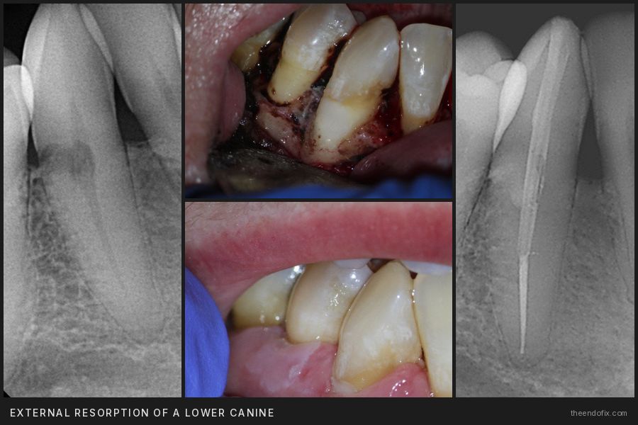 External resorption of a lower canine: radiographs, surgery and healing