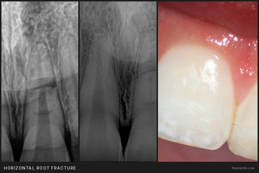 Horizontal root fracture case: preop and recall radiographs with clinical photo