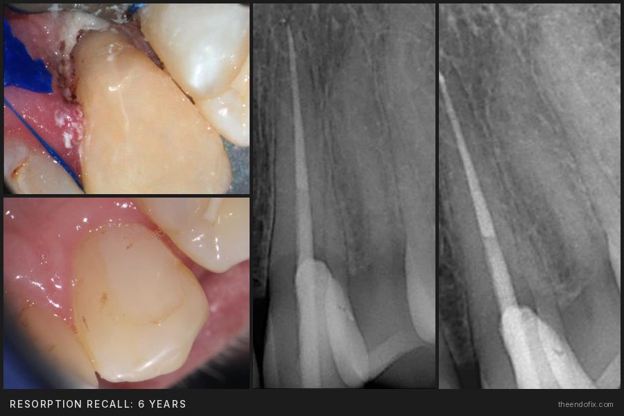 Resorption repair with 6-year recall photos and radiographs