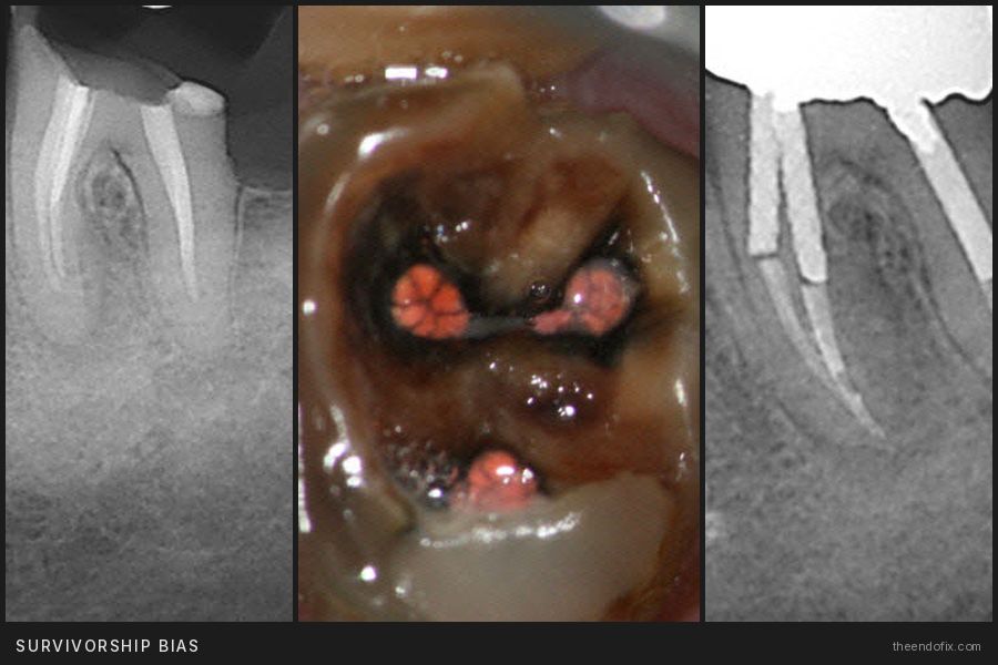 Survivorship bias retreatment case: radiographs and clinical photo